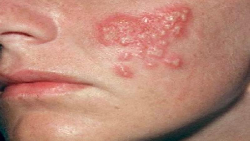 انواع راش پوستی