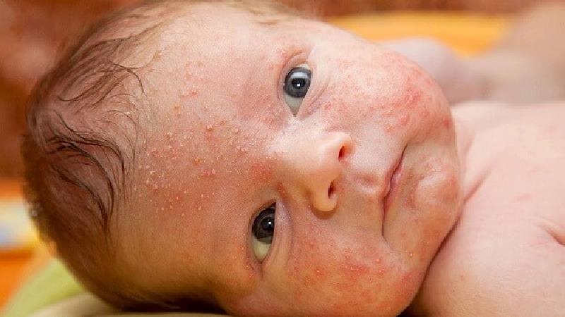 راش پوستی در کودکان 