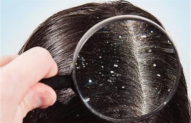 از بین بردن شوره سر یکی از فایده های ترب سفید است