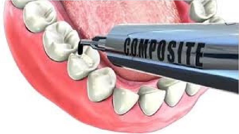 کامپوزیت ونیر دندان دقیقا چیست