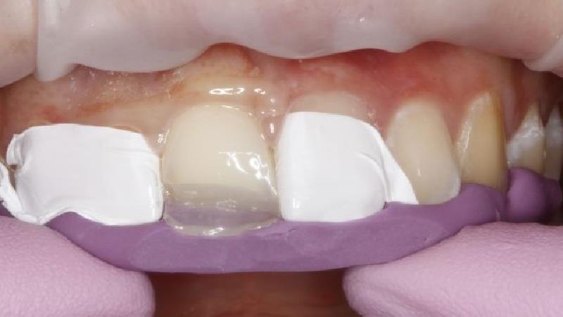 کامپوزیت دندان به چه مراقبت هایی احتیاج دارد