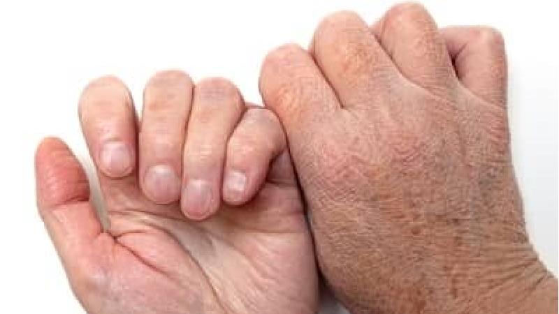 خشکی پوست یکی از علائم کمبود ویتامین سی در بدن است