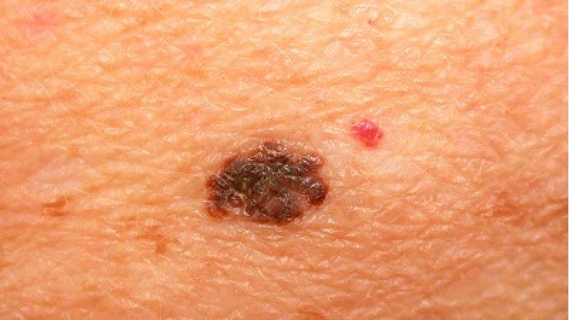 ملانون یکی از انواع سرطان پوست است