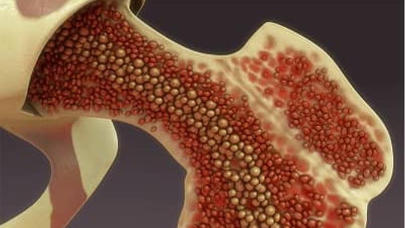 آیا سرطان مغز استخوان را می توان درمان کرد