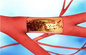 برای کاهش چربی خون چه باید کرد