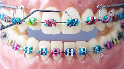 چه سنی برای ارتودنسی مناسب تر است