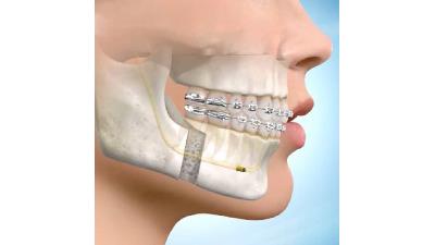 عقب انداختن ارتودنسی چه عوارضی دارد