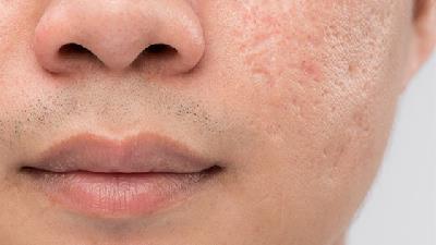 چگونه می توان اسکار صورت را درمان کرد