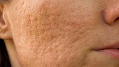 اسکار صورت به چه دلیل ایجاد می شود