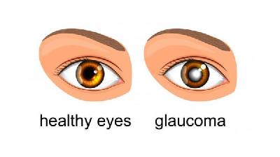 گلوکوم یا آب سیاه را چطور می توان درمان کرد