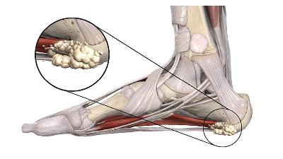 دلایل ایجاد خارپاشنه چیست