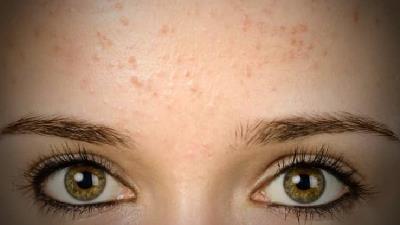 میلیا پوستی چه دلایل و درمان هایی دارد