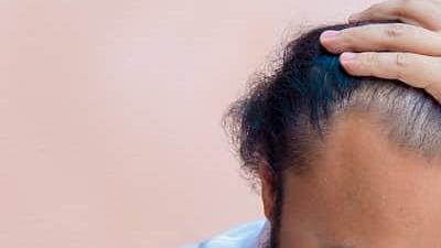 دلایل ریزش مو از دیدگاه طب سنتی چیست