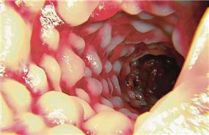 برای پاکسازی روده بزرگ چه خوراکی هایی مفید است