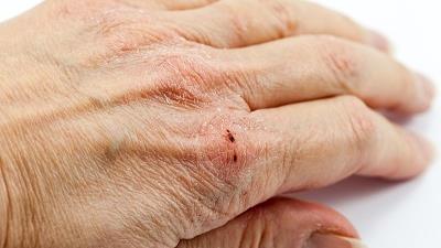 مفیدترین راه های برای رفع خشکی دست