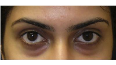 سیاهی زیر چشم چه دلایل و علت هایی دارد