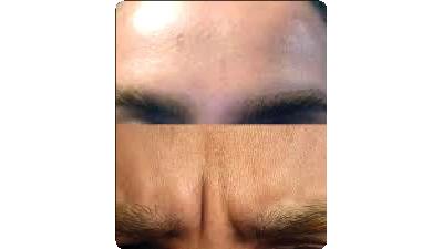 خط اخم را چگونه می توان با شیوه های خانگی برطرف کرد