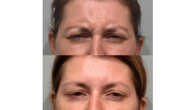 روش های طبیعی برای از بین بردن خط اخم چیست