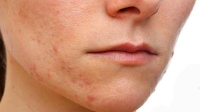 برای درمان اگزمای صورت چه باید کرد