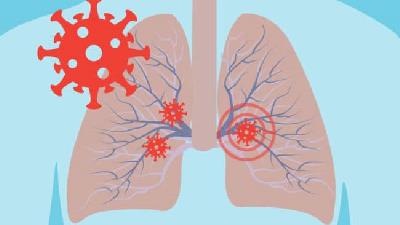 درگیری ریه با کرونا چه علائم و نشانه هایی دارد