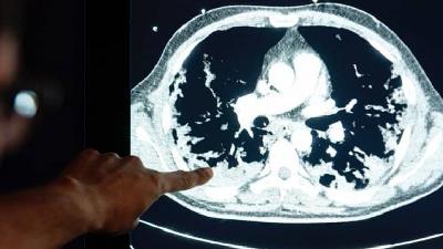 برای پیشگیری از درگیری ریه با کرونا چه کار کنیم