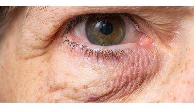 چه مواد طبیعی و خانگی پف زیر چشم را از بین می برند