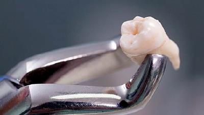 آیاد دندان عقل را حتما باید کشید