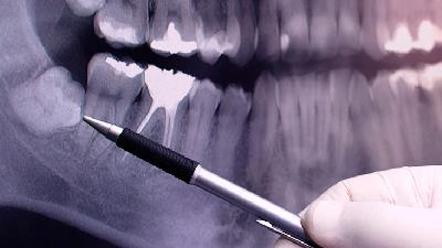 با دندان عقل نهفته چه باید کرد