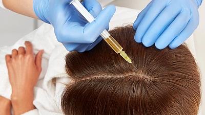 روش انجام مزوتراپی مو چگونه است