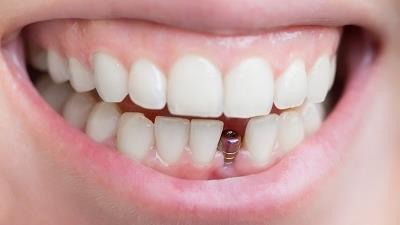 چه افرادی می توانند ایمپلنت دندان انجام بدهند