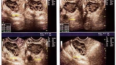 تخمدان پلی کیستیک چه علایمی دارد