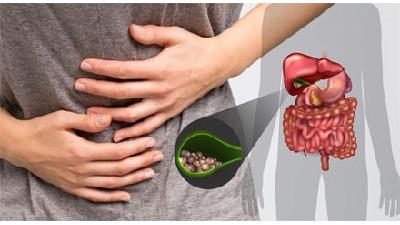 سنگ صفرا چه علائمی دارد