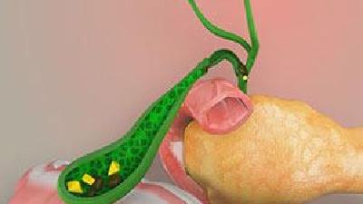 روشطب سنتی برای درمان سنگ صفرا چیست