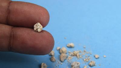 دلایل ایجاد سنگ کلیه از نظر طب سنتی چیست