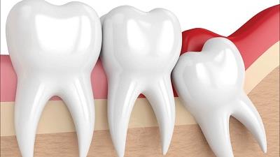 جراحی دندان نهفته چقدر ضروری است