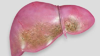 کبد چرب چه علائمی دارد