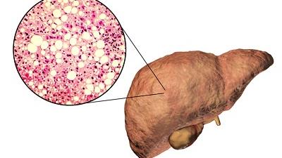 علائم مربوط به چرب شدن کبد را جدی بگیرید