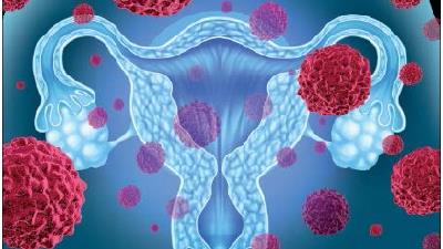 سرطان دهانه رحم چه علائمی دارد