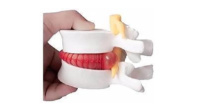 دیسک کمر غیر از جراحی چه درمان های دیگری دارد