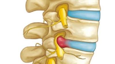 برای کمتر شدن درد دیسک کمر چه کار کنیم