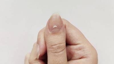 آیا لکه های سفید روی ناخن نشان دهنده مریضی است