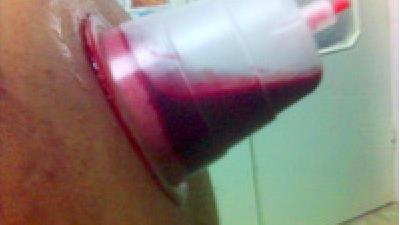 بعد از انجام حجامت چی بخوریم