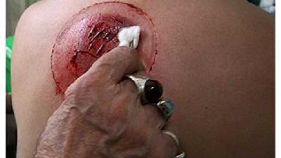 پرهیز غذایی قبل از حجامت چگونه است