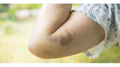 گرما برای درمان کبودی بدن خوب است