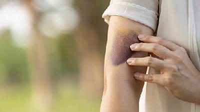 با روش های درمان خانگی کبودی آشنا شوید