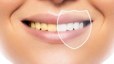 بلیچینگ دندان و مزیت های باورنکردنی آن