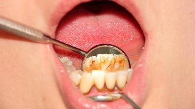 روش خانگی پاک کردن جرم دندان