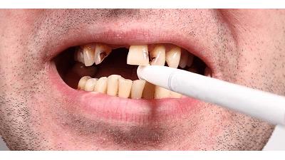 قیمت ایمپلنت دندان در کشورهای مختلف