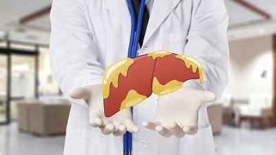 با علائم کبد چرب آشنا شوید