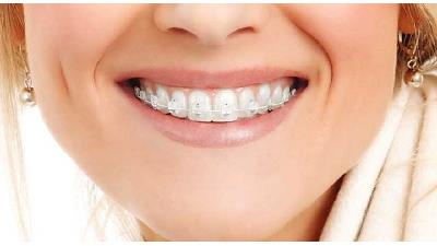 آیا ارتودنسی فقط جنبه زیبایی داد؟